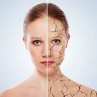 dry-vs-hydrated-skin